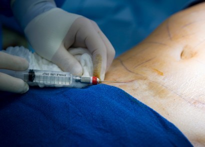 A man receiving liposuction surgery.
