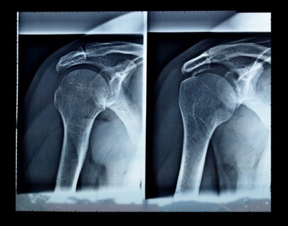 A blue x-ray of an injured shoulder.