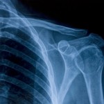 A skeletal x-ray focussing on the shoulder.