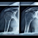 A blue x-ray of an injured shoulder.